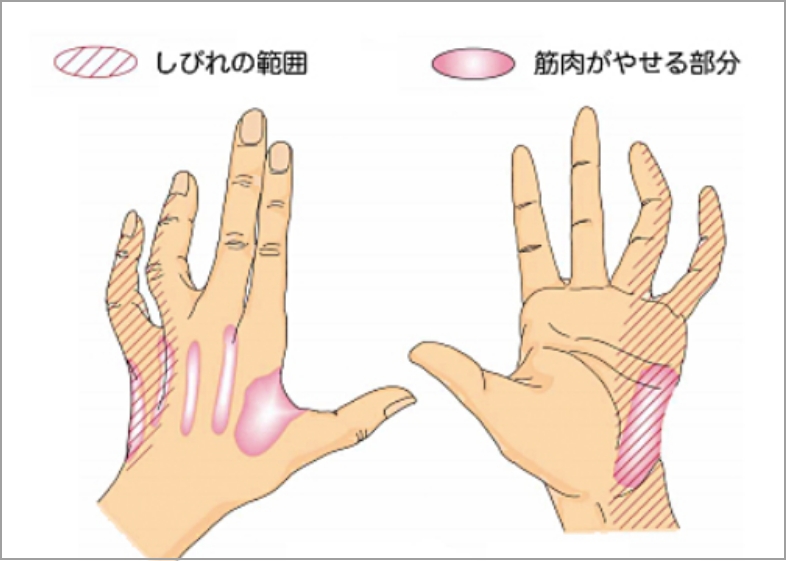 しびれの範囲と筋肉がやせる部分の図