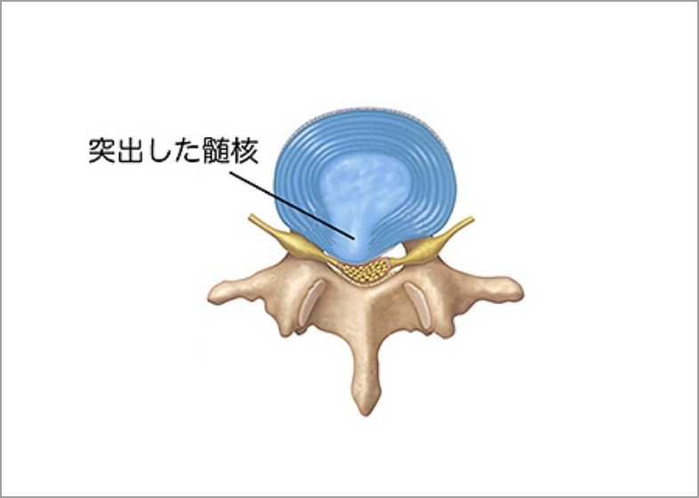 椎間板ヘルニア上図