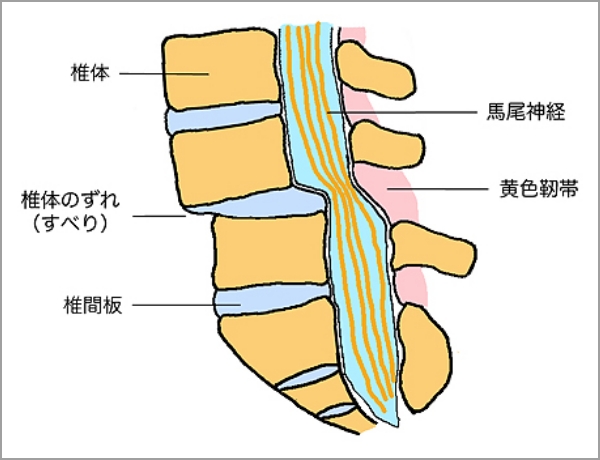 腰椎すべり症