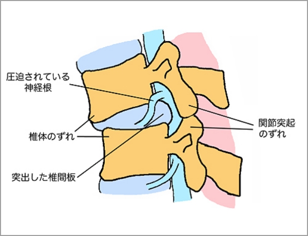 腰椎変性すべり症