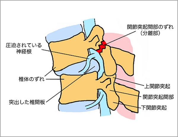 腰椎分離すべり症