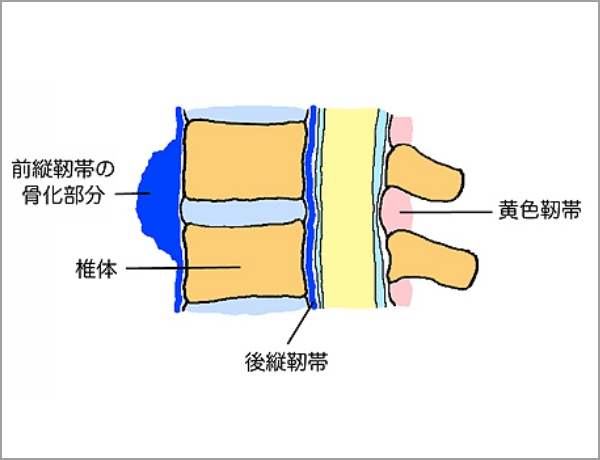 前縦靱帯が骨化した図