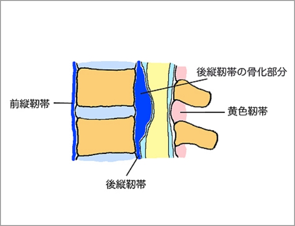 後縦靱帯が骨化した図