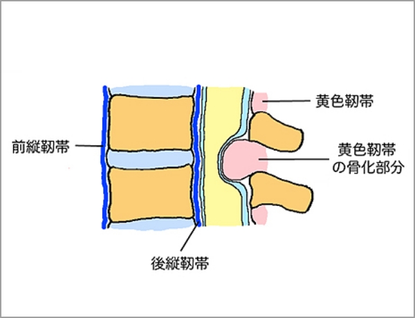 黄色靱帯が骨化した図