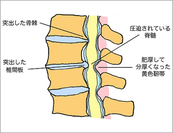 脊柱管狭窄症の図