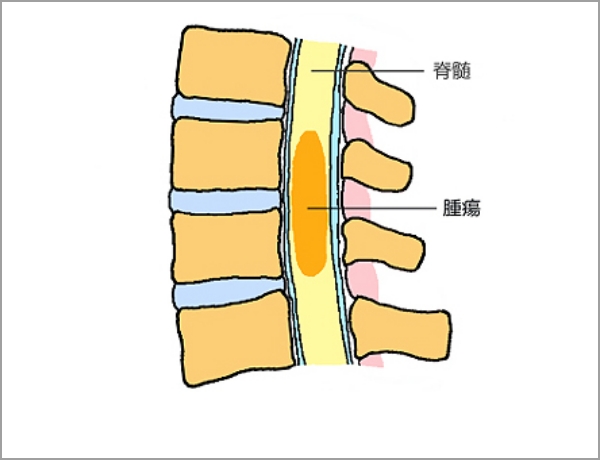 脊髄髄内腫瘍