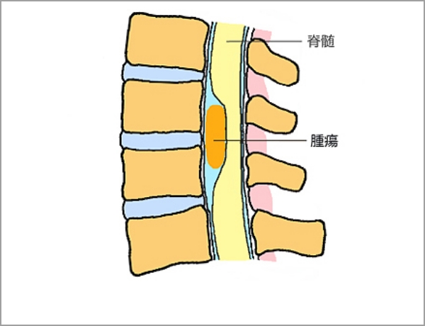 硬膜内髄外腫瘍