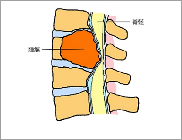 硬膜外腫瘍