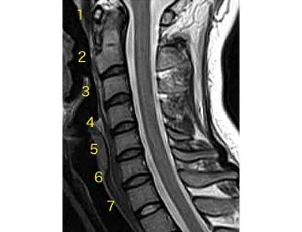 24歳女性 頚椎（正常所見）