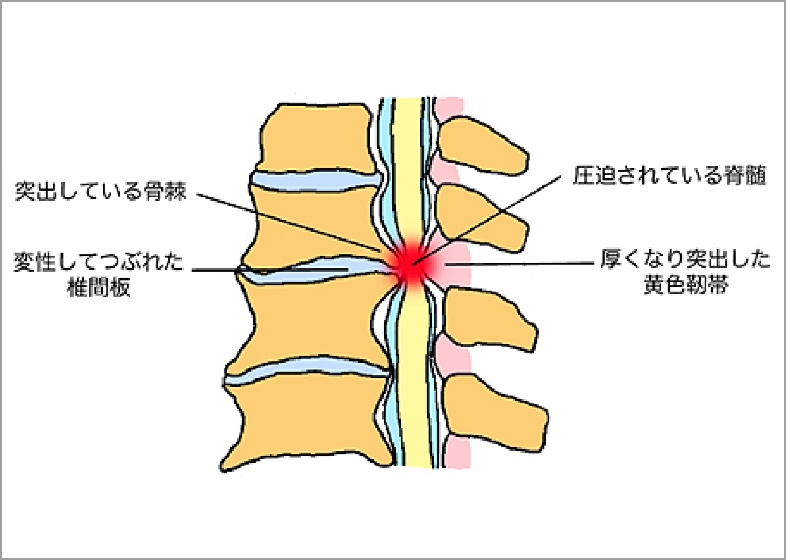 変形性脊椎症