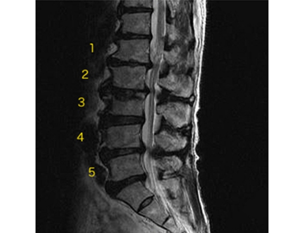 変形性腰椎症
