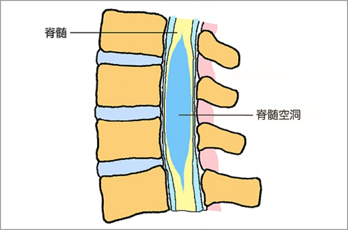 脊髄空洞症